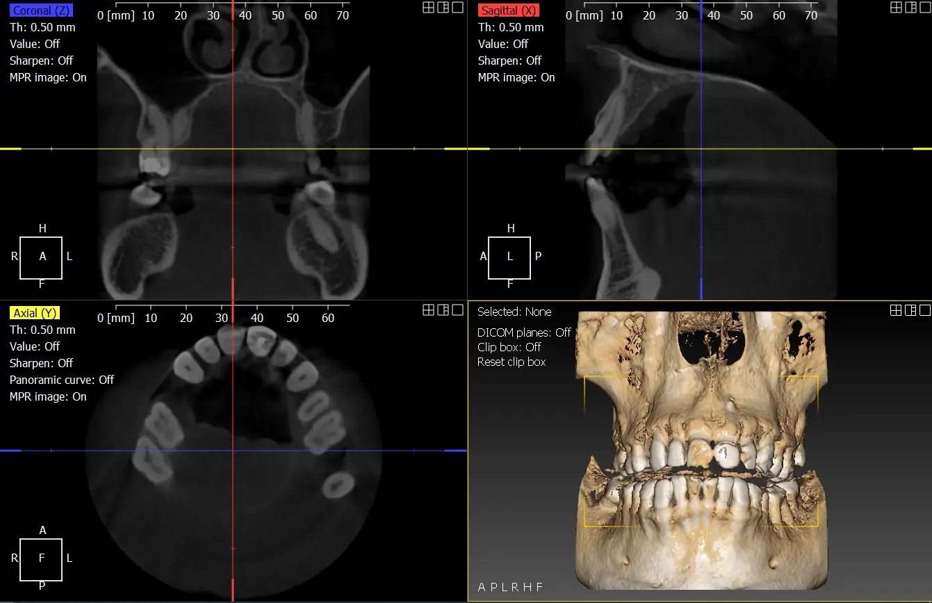 CT1